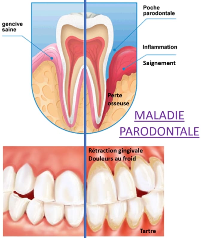maladie-parodontale