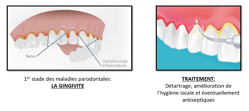 maladies parodontales