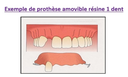 Prothese amovible